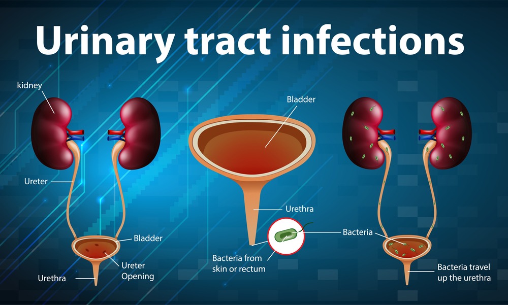Urinary Tract Infection: How to Treat It Fast, Safely, and Effectively post thumbnail image