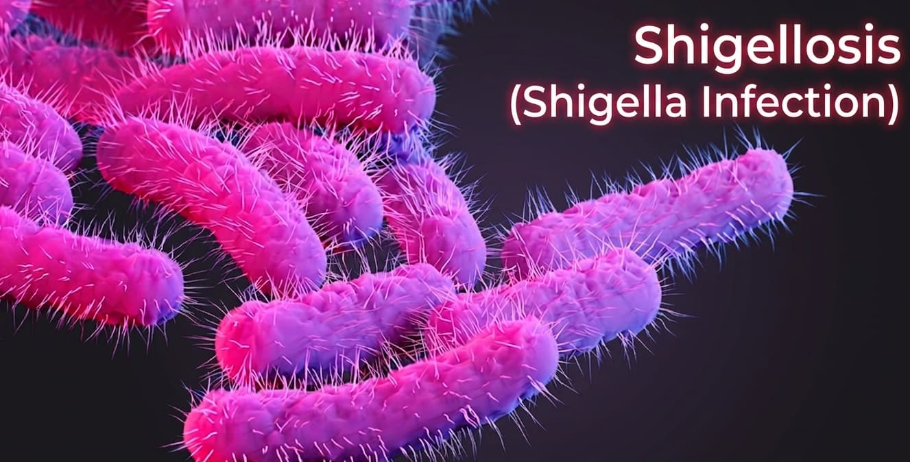 Drug-Resistant Shigellosis Symptoms and Prevention Guide post thumbnail image