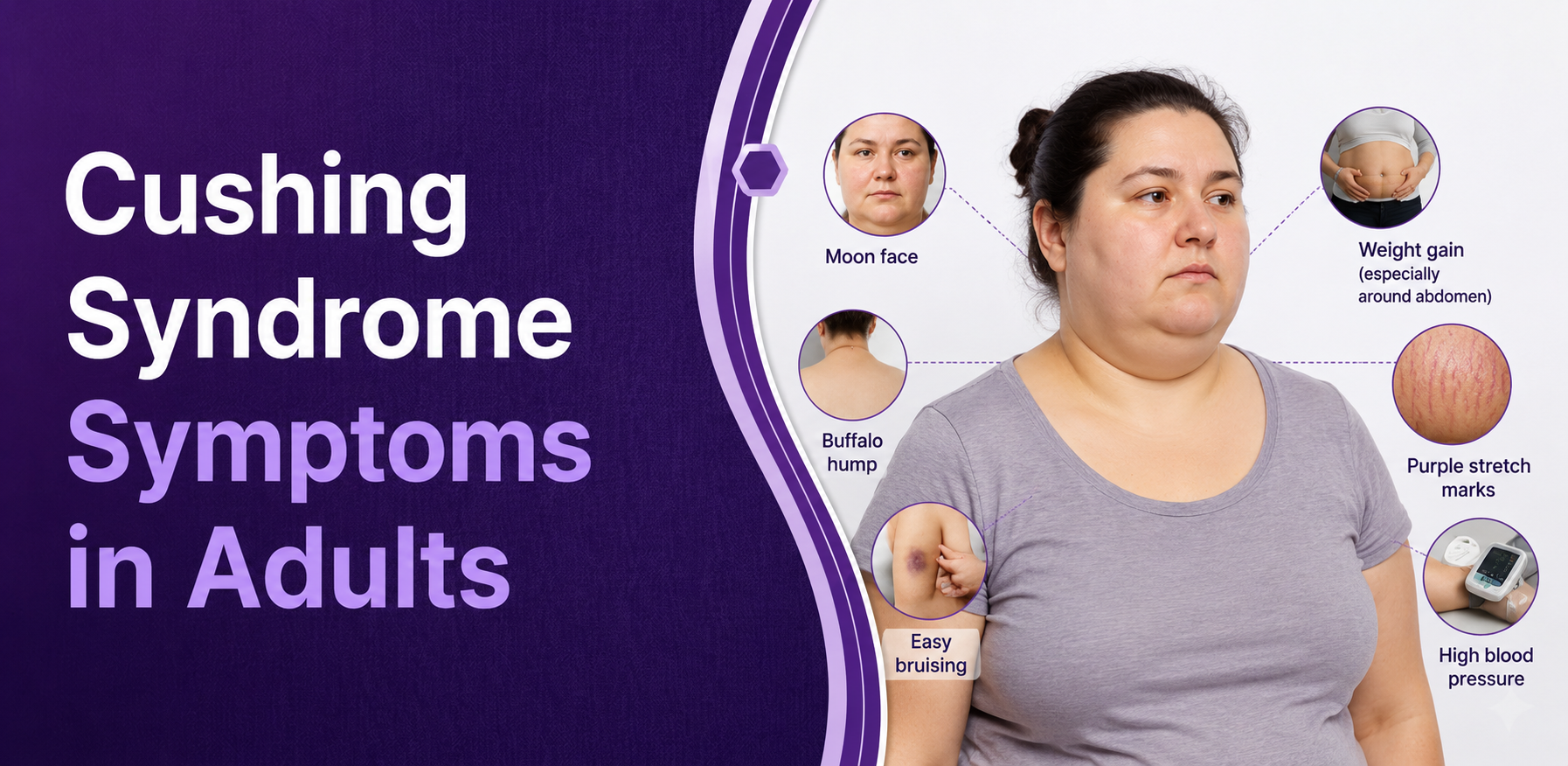 Cushing Syndrome Symptoms in Adults: Early Signs, Causes, Tests & Treatment post thumbnail image