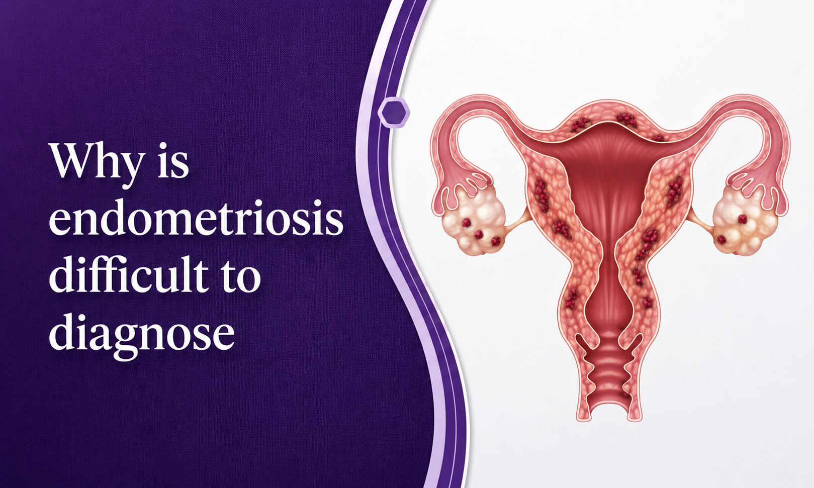 Why Is Endometriosis Difficult to Diagnose? Understanding the Delays post thumbnail image