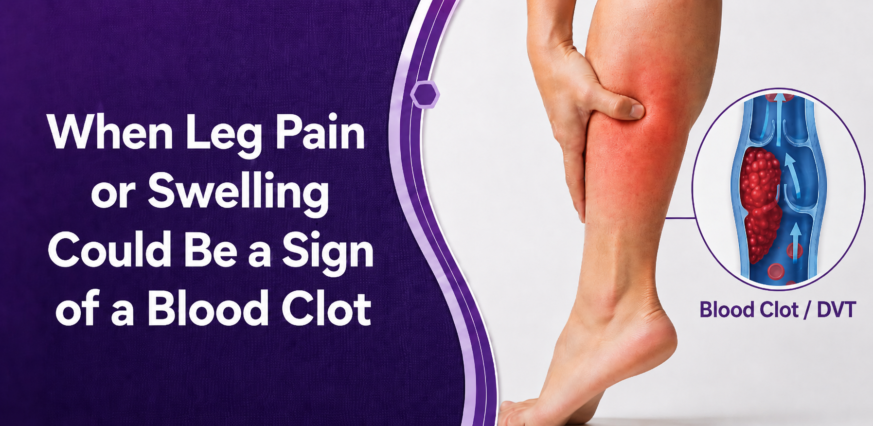 When Leg Pain or Swelling Could Be a Signs of a Blood Clot