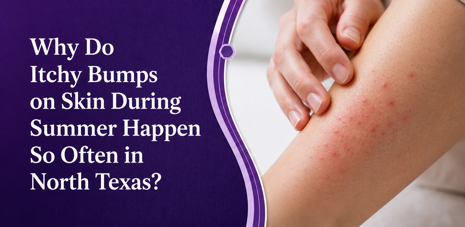 Why Do Itchy Bumps on Skin During Summer Happen So Often in North Texas?
