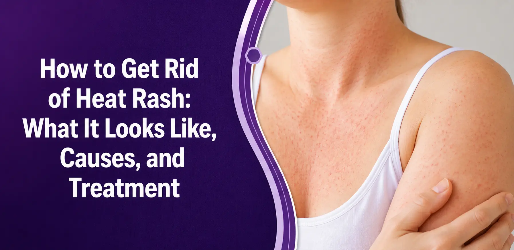 How to Get Rid of Heat Rash: What It Looks Like, Causes, and Treatment