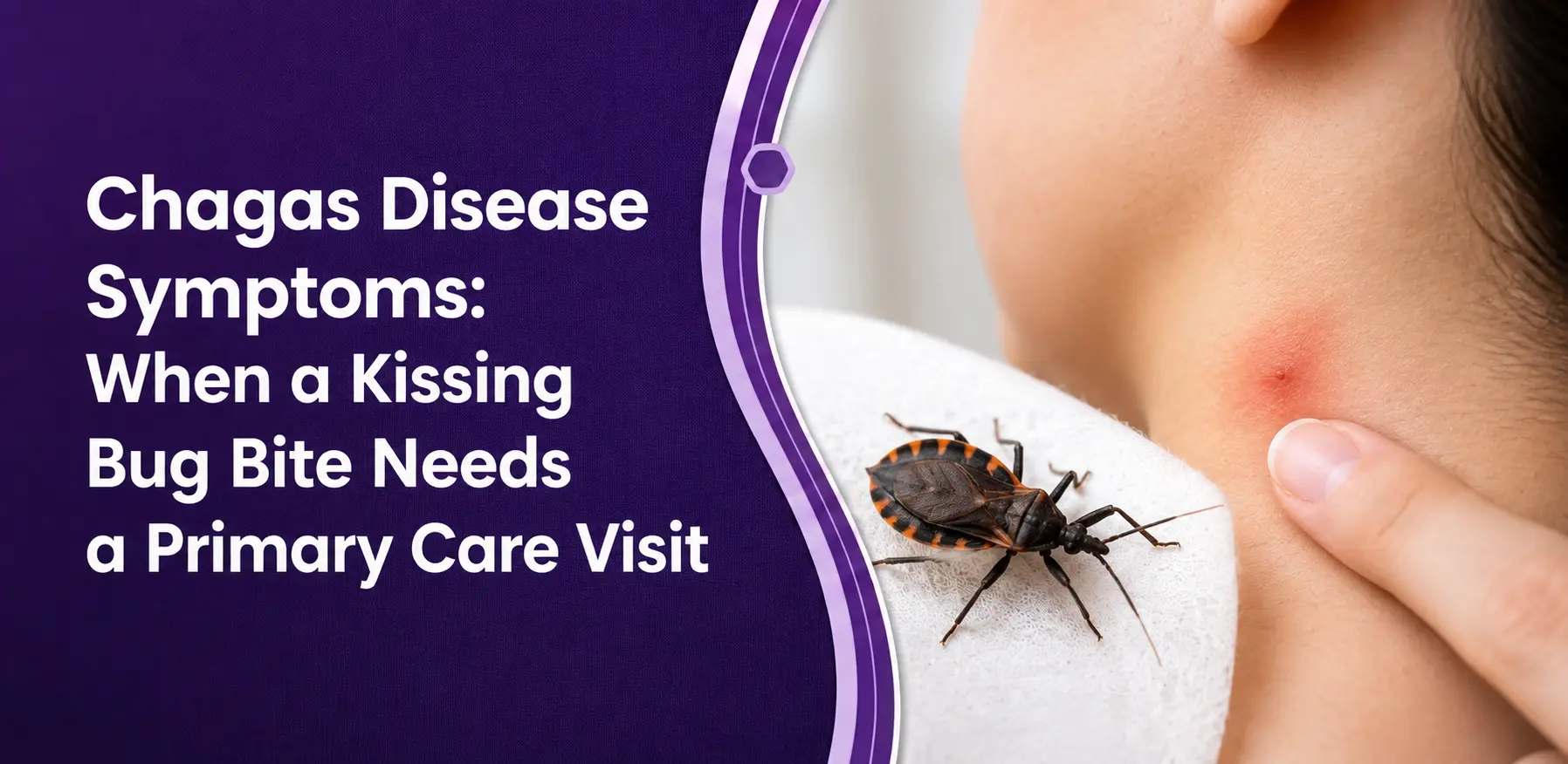 Chagas Disease and Kissing Bug Bite