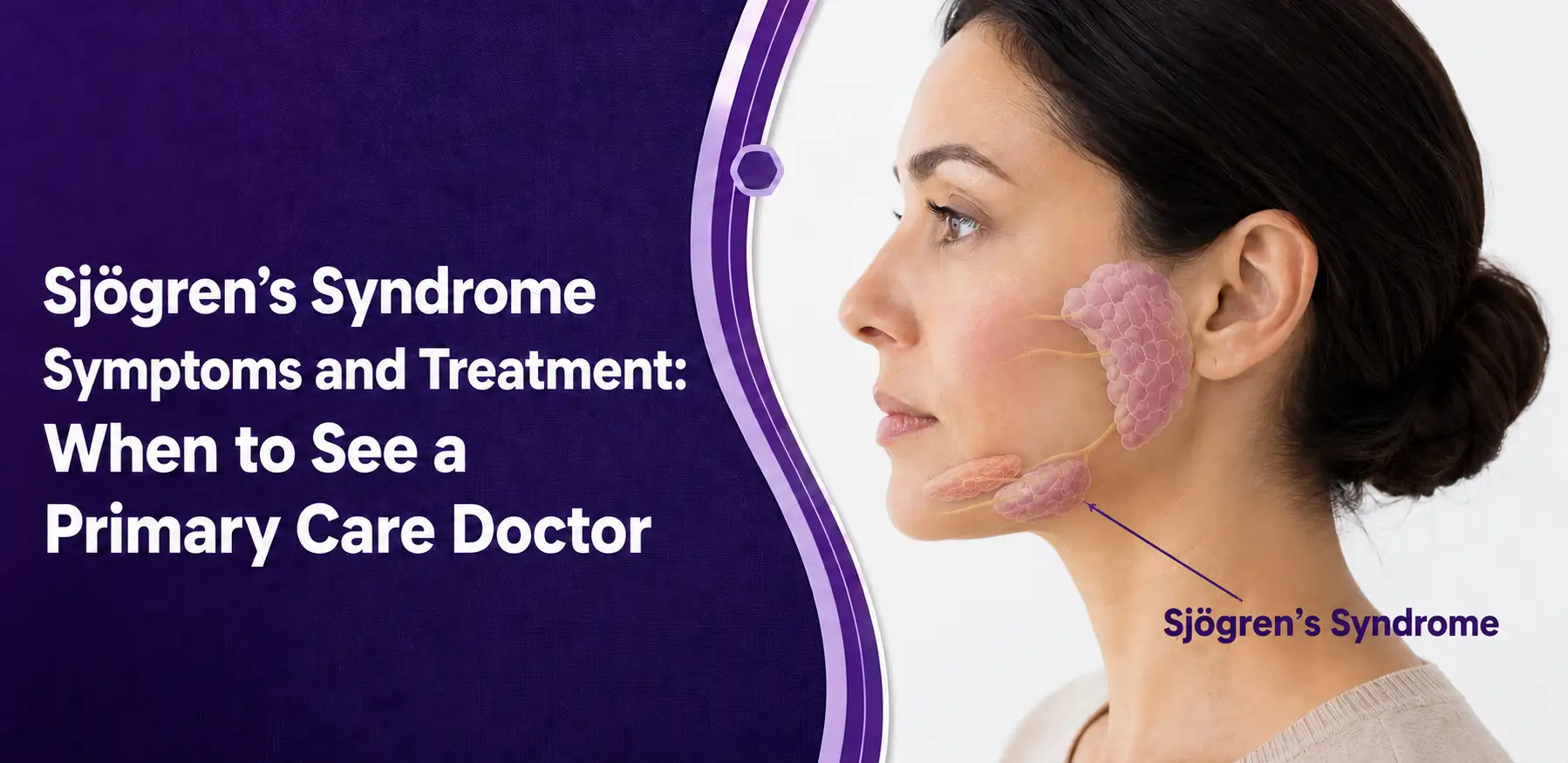 Sjögren’s Syndrome Symptoms and Treatment