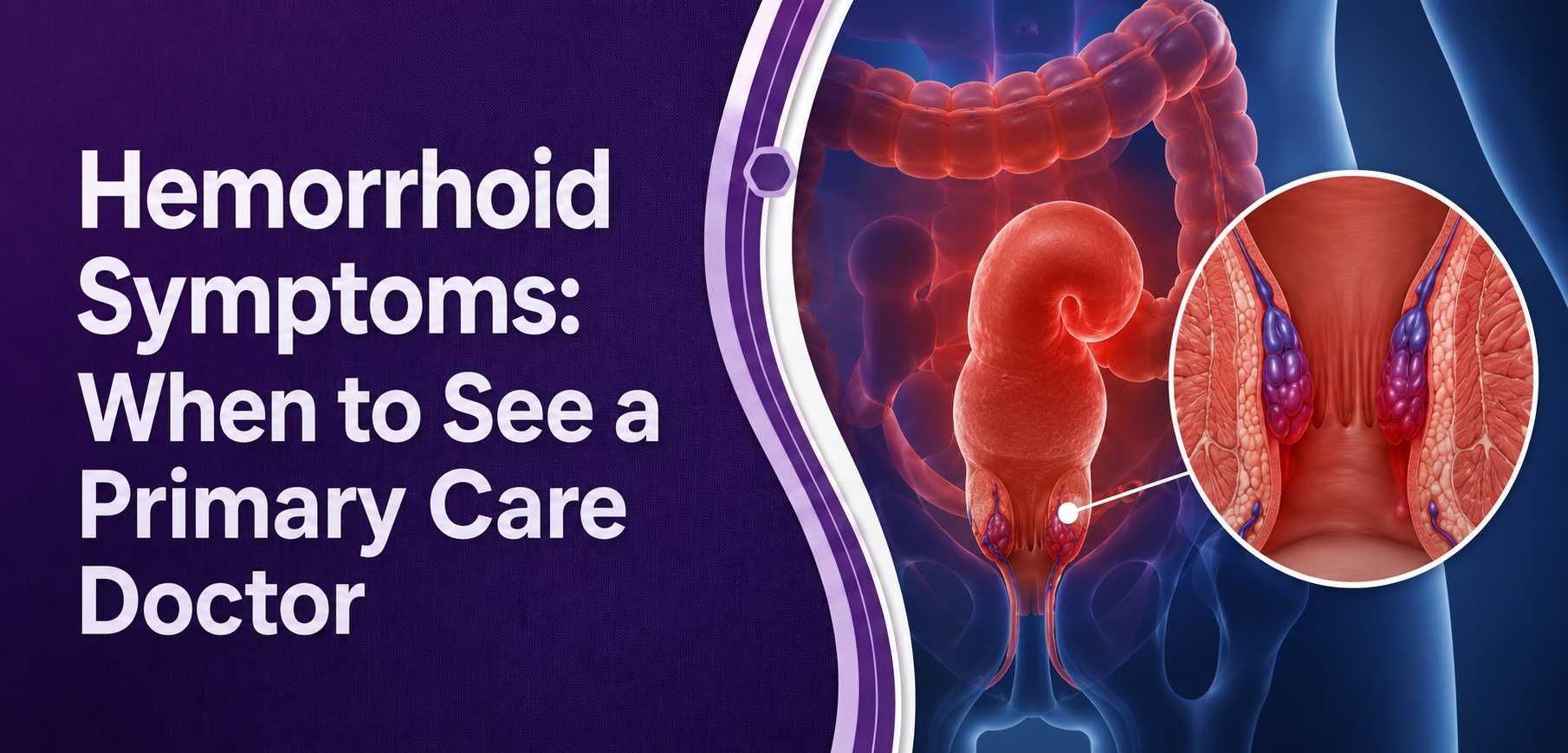 Hemorrhoid Symptoms: When Should You See a Primary Care Doctor?