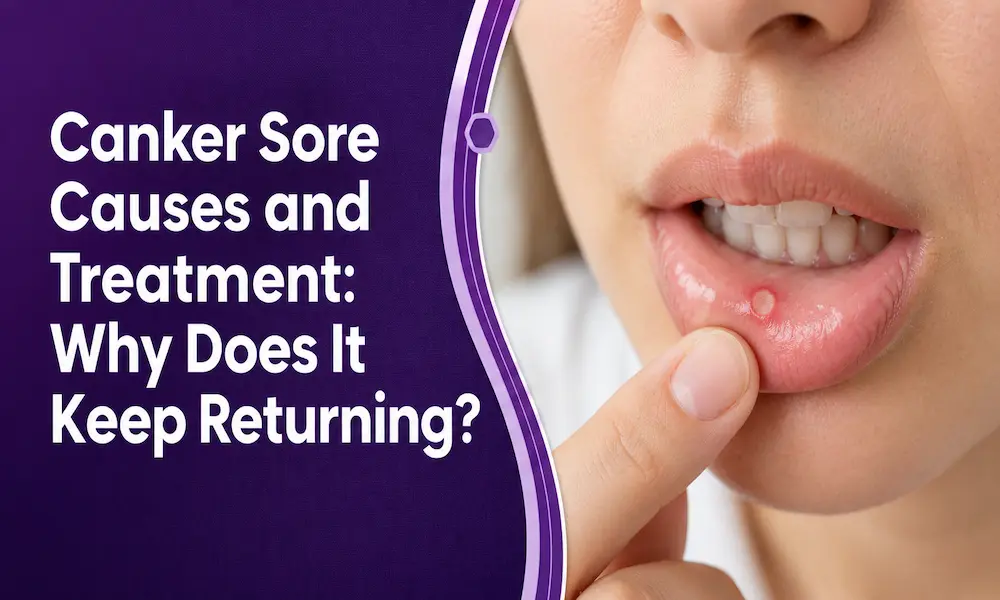 Canker Sore Causes and Treatment: Why Does It Keep Returning? post thumbnail image