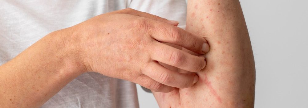 The Ultimate 2026 Ringworm Guide: 7 Effective Ways to Treat and Stop the Spread